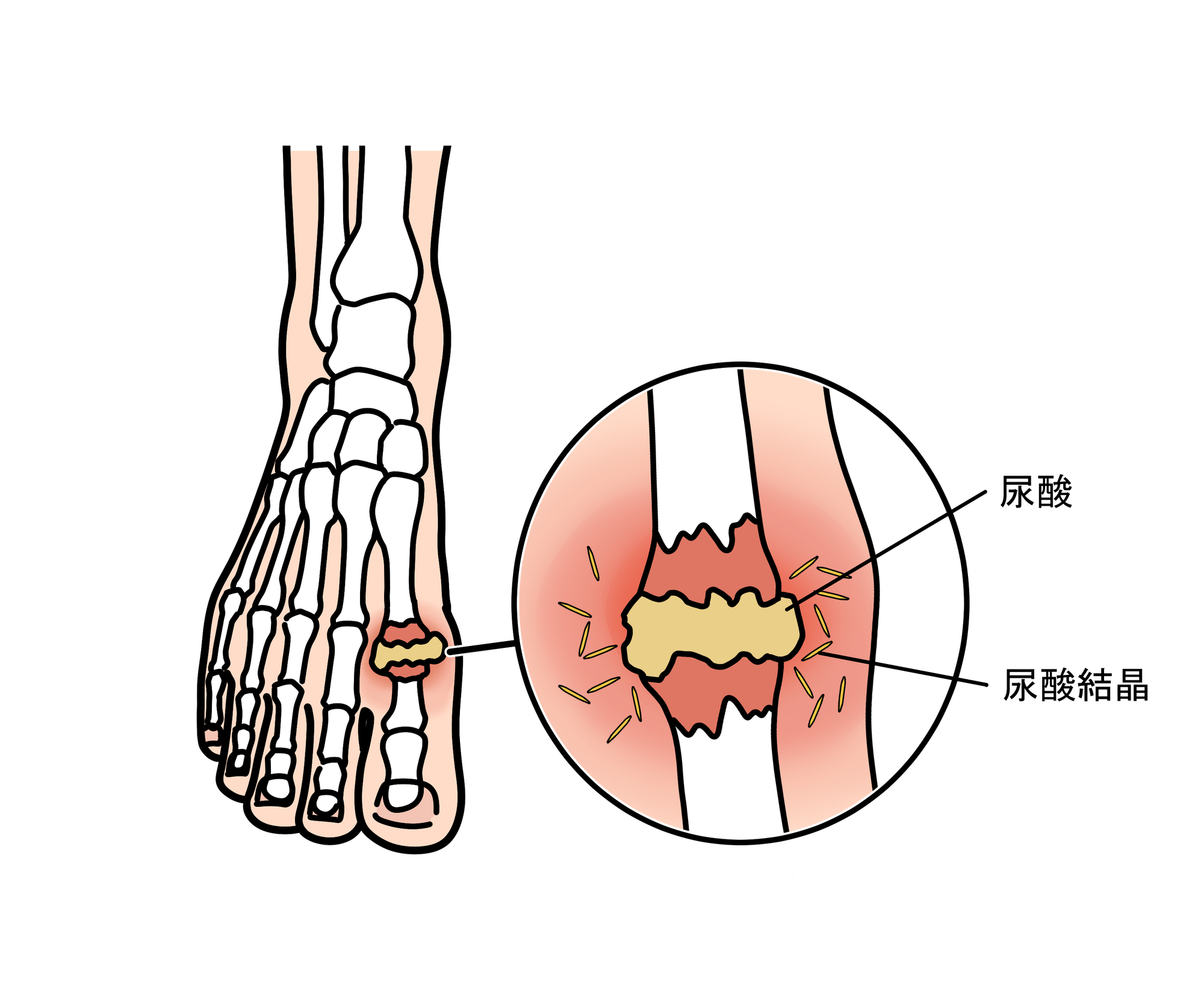 こんな症状は痛風(高尿酸血症)の場合があります